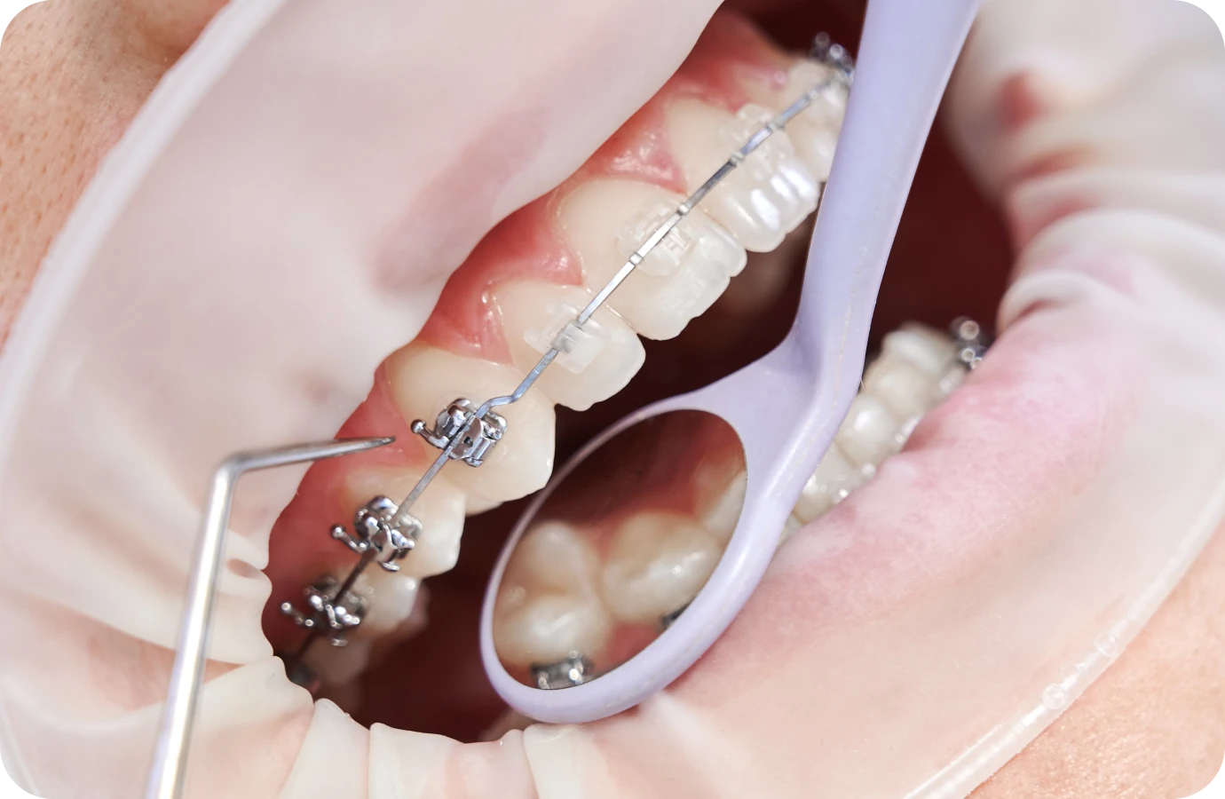 Perte ou décollement d’un appareil