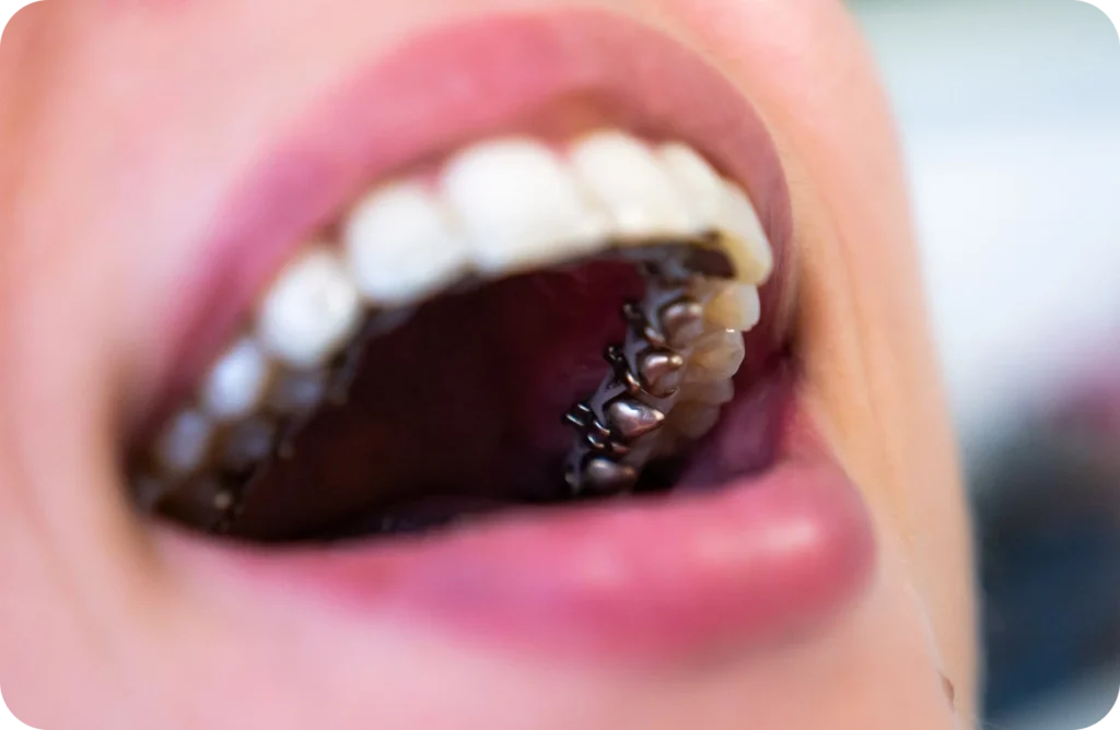 Orthodontie linguale